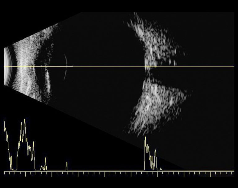 Ultrassonografia Ocular